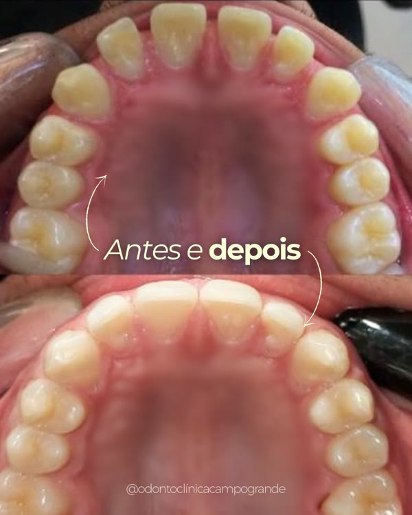Antes e depois da arcada com alinhadores