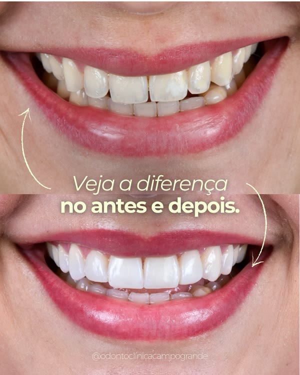 Antes e depois de facetas em resina