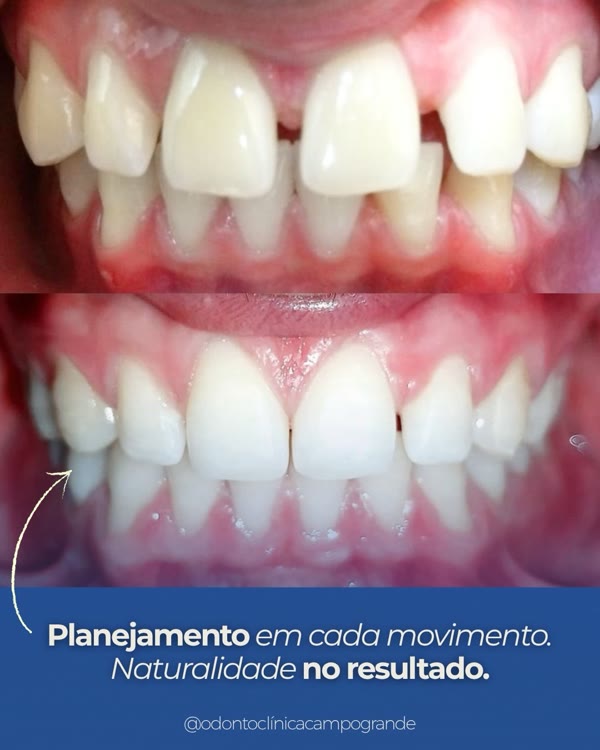 Sorriso com espaços fechados e aparência natural