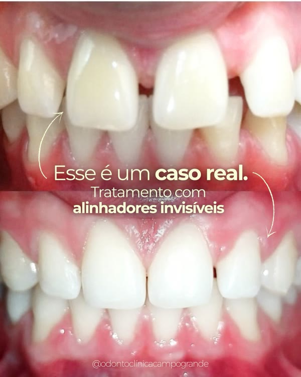 Antes e depois do fechamento de espaços com alinhadores